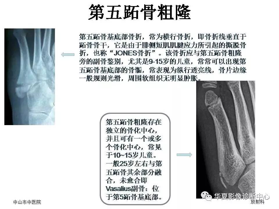 籽骨,副骨及永存骨骺,请别再误诊!