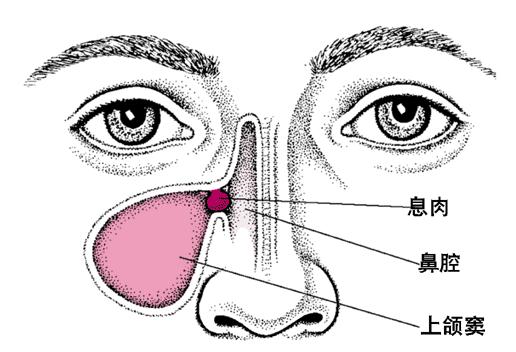 鼻窦炎中医五种辨证型治疗