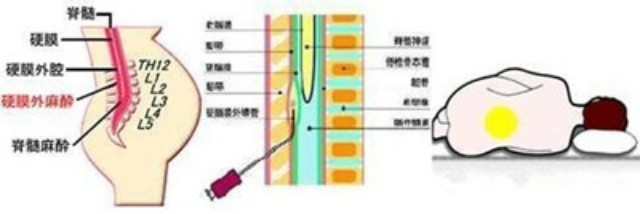 产后一个月腰疼怎么办