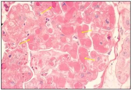 图 19 六胺银染色 黄色箭头:肾小球毛细血管腔内透明样血栓形成;红色