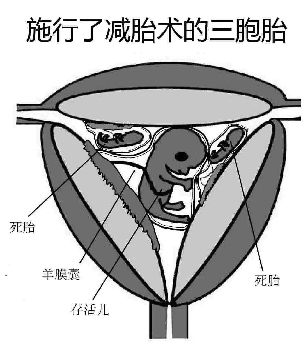 王女士 减胎手术主要是利用b超,找到胎儿心脏地点位置,再将穿刺针