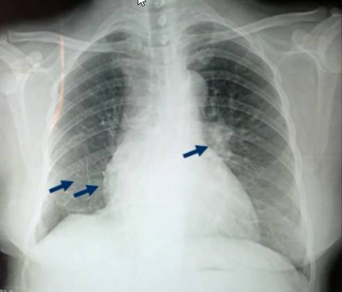 5. 胸部ct:可见右侧肺纹理明显稀疏减少.