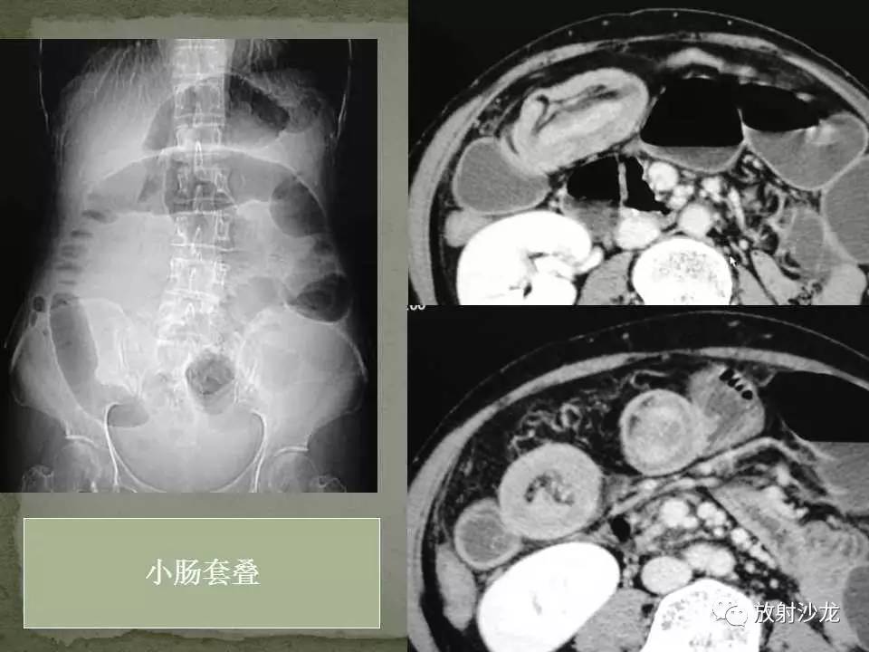 课程学习 | 肠梗阻的ct影像诊断