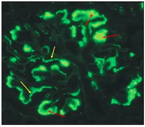 肾内病理图解:有形结构沉积肾小球病
