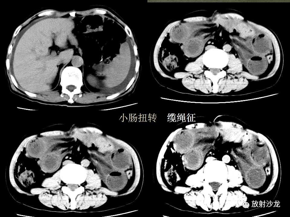 课程学习 | 肠梗阻的ct影像诊断