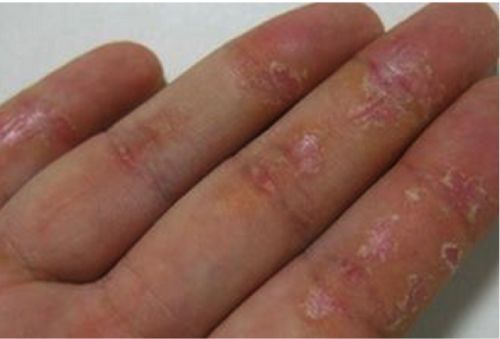 手足皲裂和汗疱疹该如何区分