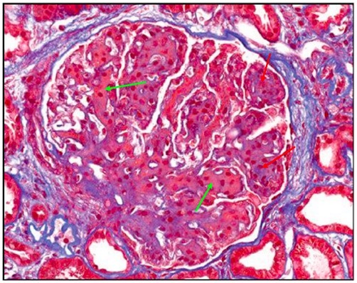 肾内病理图解:有形结构沉积肾小球病