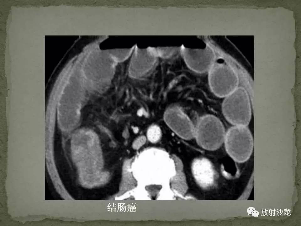 课程学习 | 肠梗阻的ct影像诊断