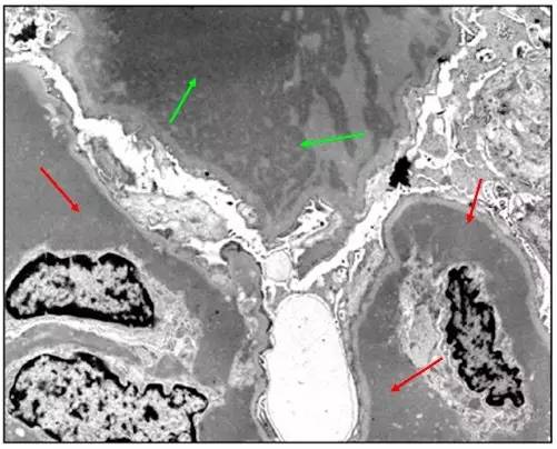 肾内病理图解:有形结构沉积肾小球病