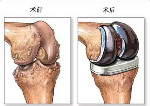 哪些情况适宜做人工全膝关节置换术