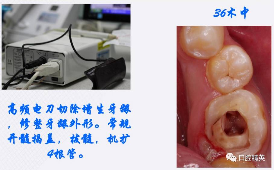 牙龈增生及牙髓息肉伴4根管病例治疗1例