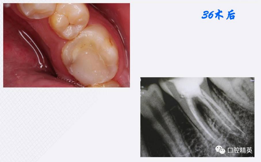 牙龈增生及牙髓息肉伴4根管病例治疗1例