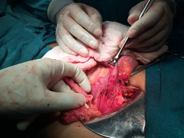 可见阑尾残株和之前的阑尾切除术疤痕在全麻状态下,行剖腹探查术,正中