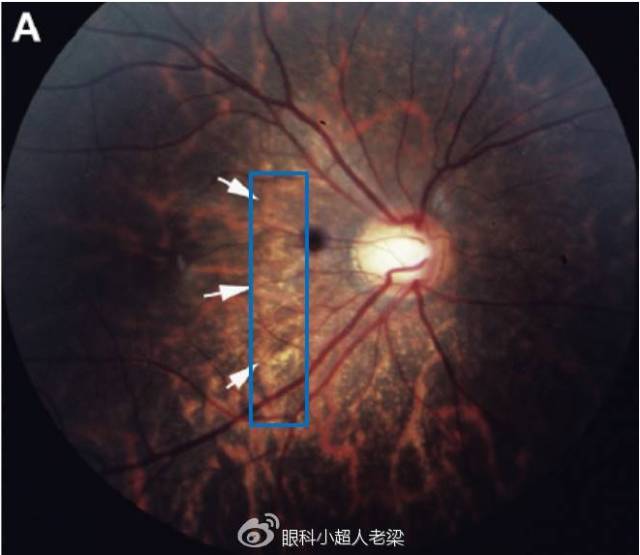 孩子会近视吗?如何预测?