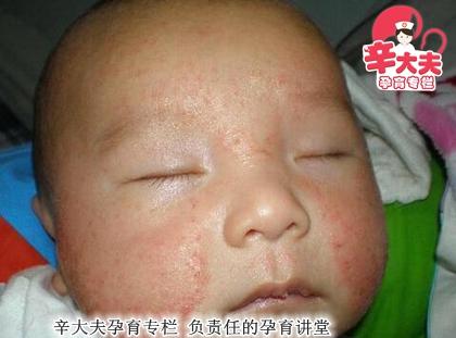 为什么婴儿老是长湿疹