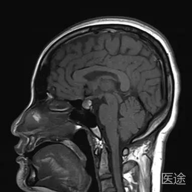 t1wi矢状位 病变信号不均