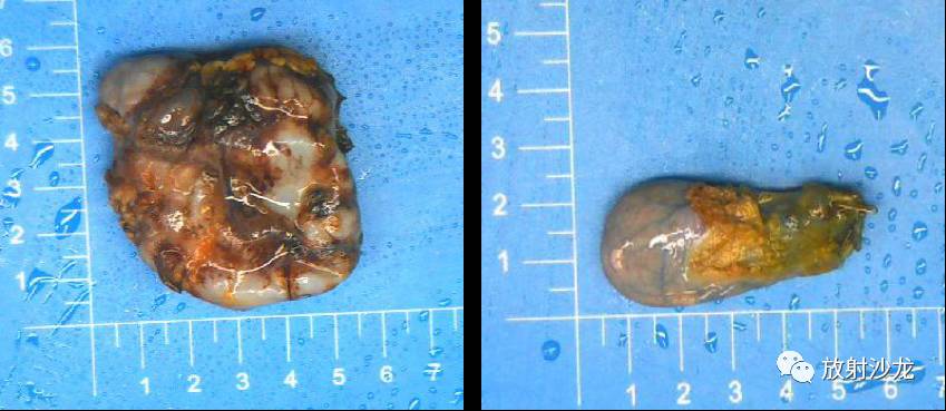 病例解析 | 胰腺粘液性囊腺瘤