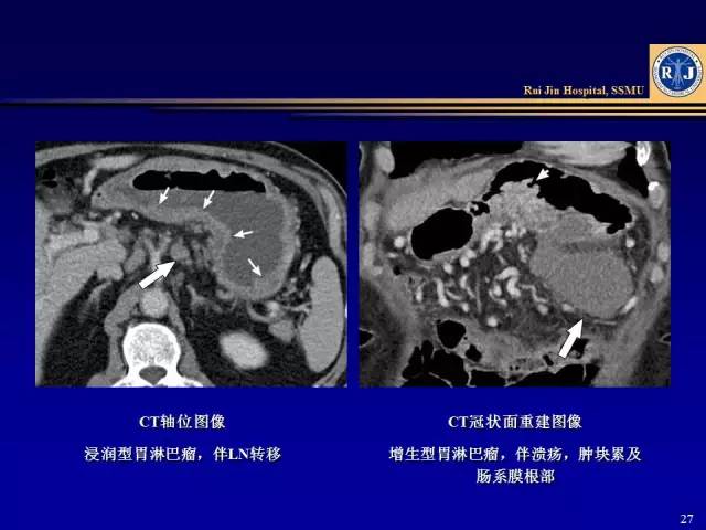 看了这篇 晋级胃癌 ct 诊断高手