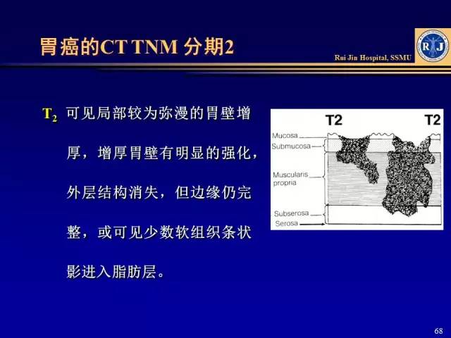 看了这篇晋级胃癌ct诊断高手