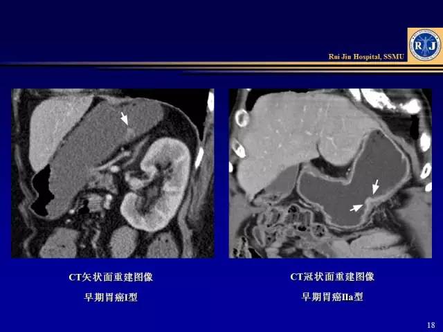 看了这篇晋级胃癌ct诊断高手