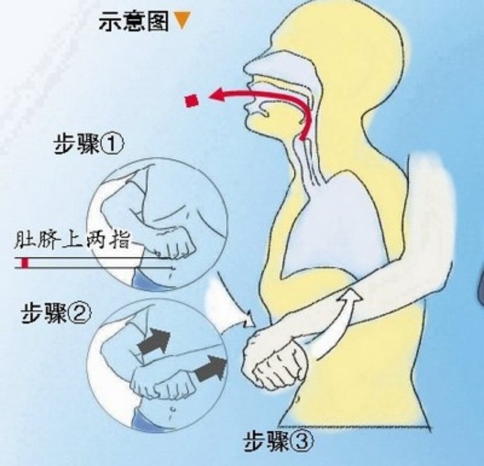 海姆利克急救法详解