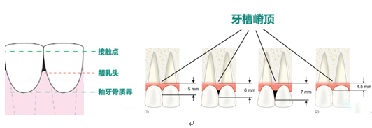 两牙接触点到牙槽嵴顶之间的垂直距离,是决定黑三角程度的重要因素.