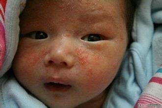 能让宝宝摆脱湿疹疾病的方法有哪些?