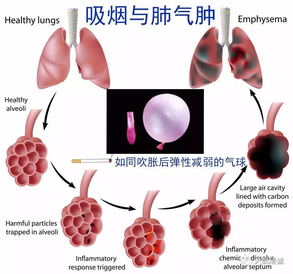 目前,公认吸烟为慢阻肺的重要发病因素,吸烟时间越长,吸烟量越大