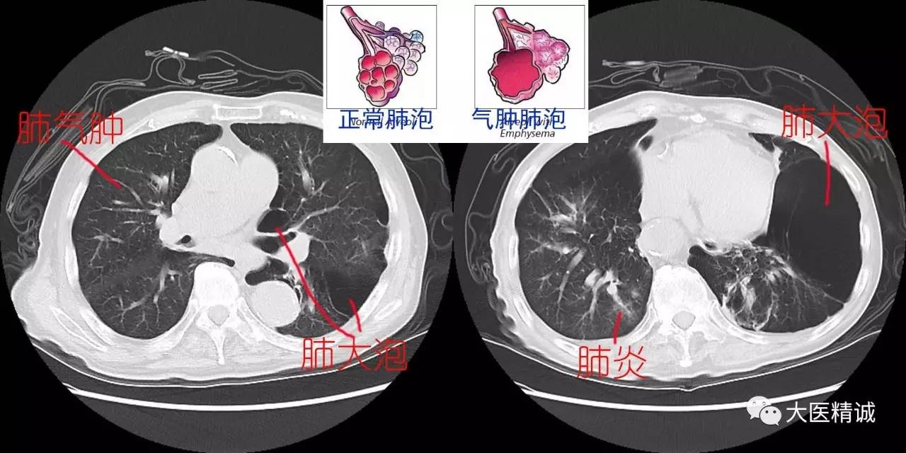 每一次呼吸都生不如死,慢阻肺离你并不远