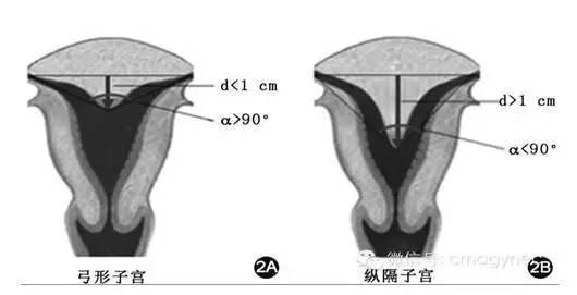 图10:弓形子宫与纵隔子宫鉴别图11:弓形子宫三维成像宫体轮廓无异常.