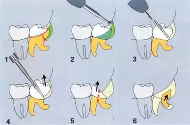 牙医必备:值得牙医收藏的拔牙技巧图解
