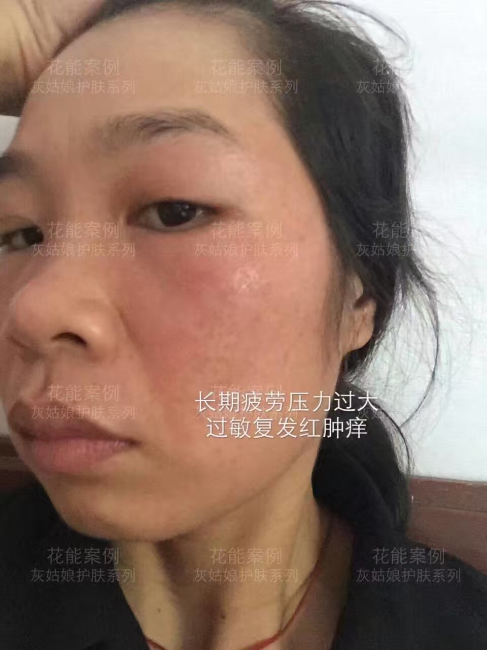 姑娘们注意了:长期乱用激素药小心变成"激素脸"