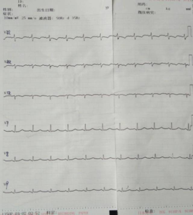 入院后再次发作颈部酸胀感,发作时心电图