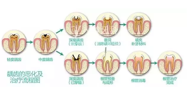 龋齿不痛,更应该补!当你发现有牙黑点就该治疗了