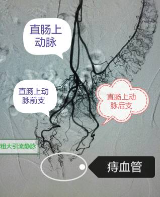 从他的右侧大腿根部穿刺一个直径约1mm左右的针眼进入右股动脉,来自xb