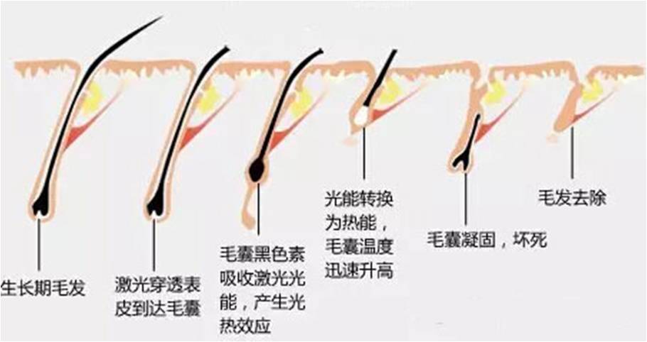 不了解这7大常识就去做激光脱毛,难怪天天过愚