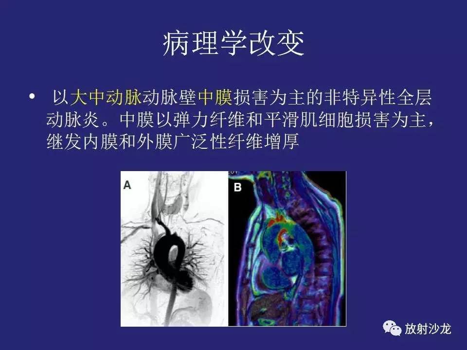 精彩课件大动脉炎分型及ct诊断