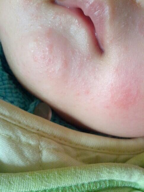 湿疹痒得很 这样洗澡可以让宝宝远离湿疹