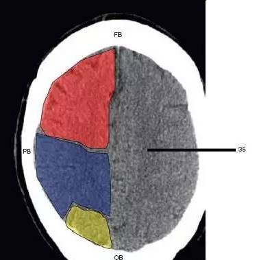 35,半卵圆中心(centrum semiovale)浅红色部分为额叶(frontal lobe)