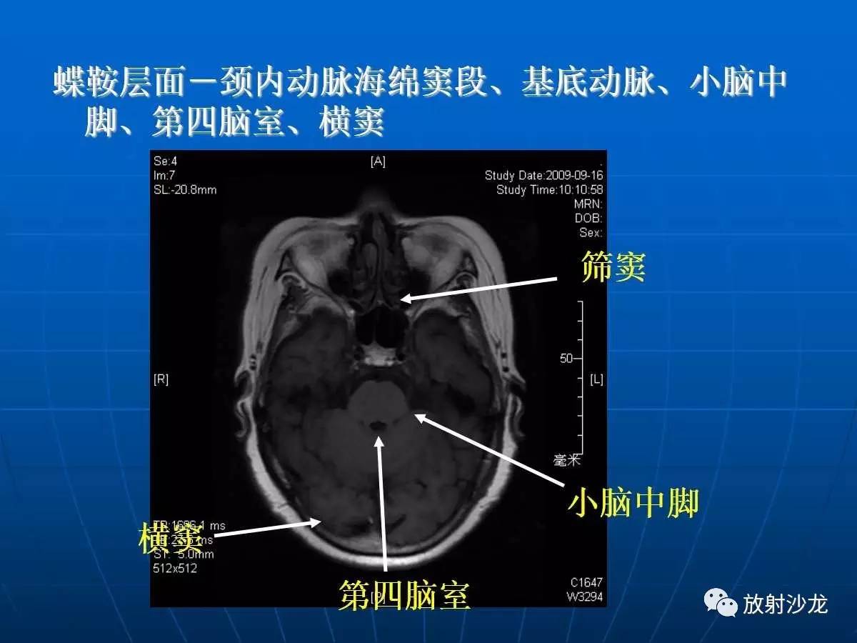 基础必备 | 脑部磁共振呈像