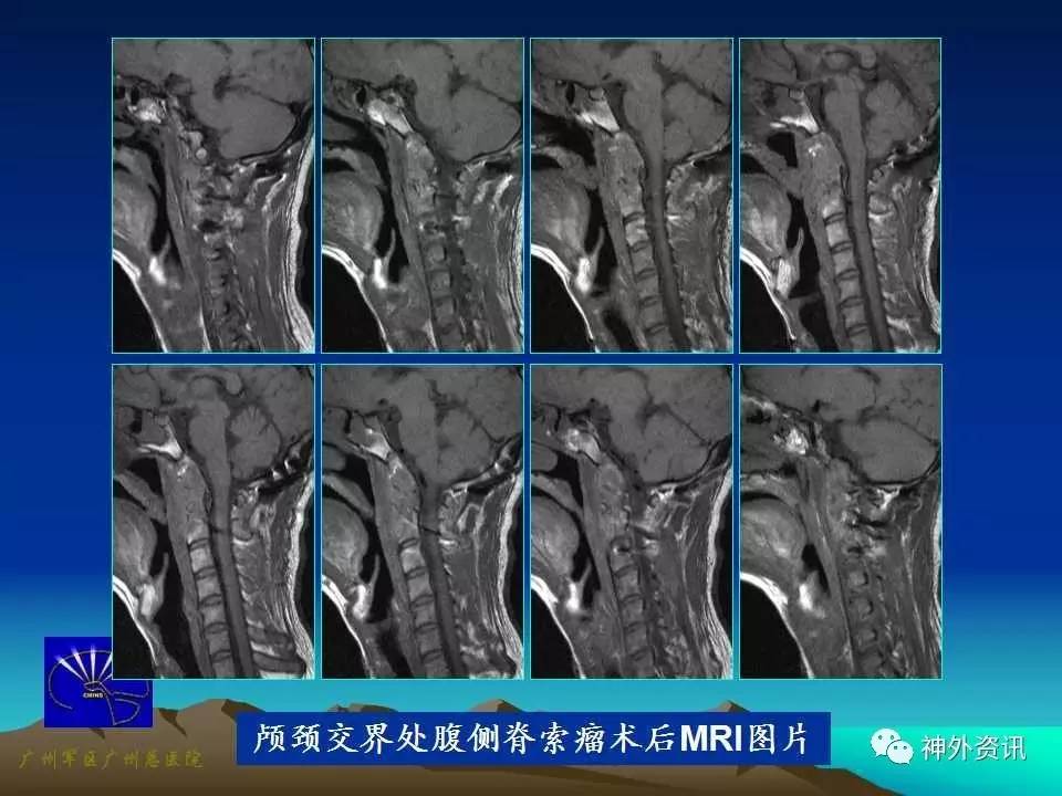 病例分享| 王国良教授:颅颈交界处腹侧脊索瘤的手术治疗策略