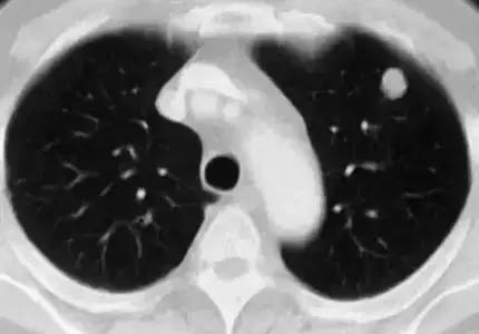 【医学科普】肺结节≠肺癌