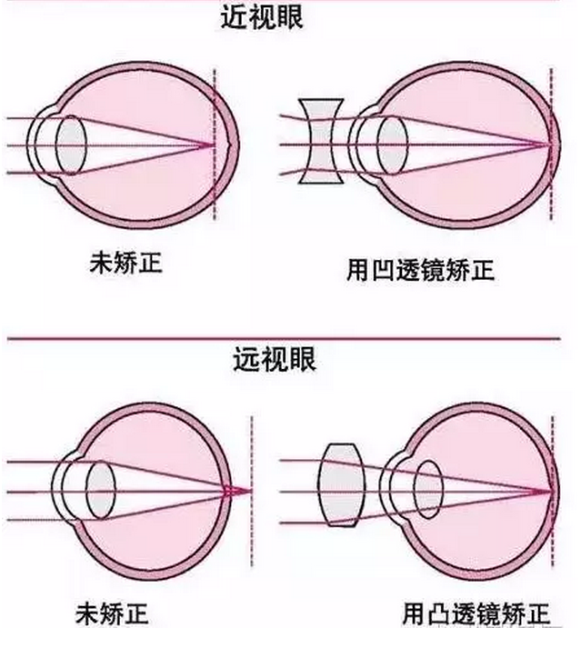 眼睛成像原理 近视眼:眼轴过长或晶状体失去调节作用导致远处的光线