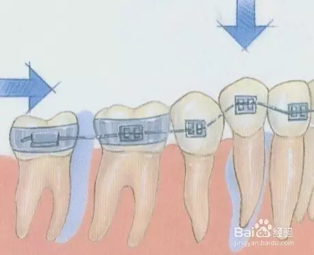正畸牙齿移动的原理_正畸中牙齿移动的原理(3)