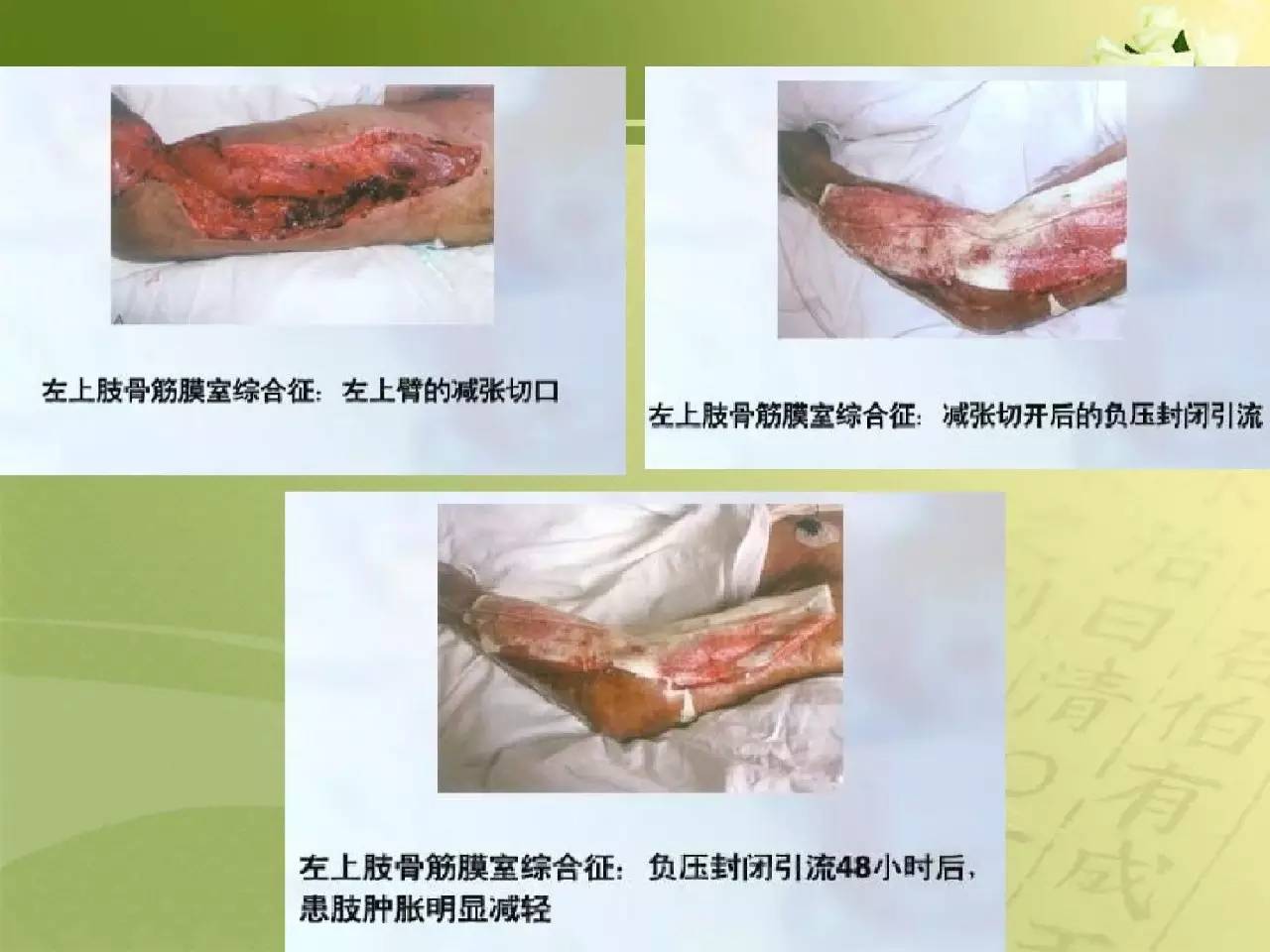 骨筋膜室综合征的观察及护理