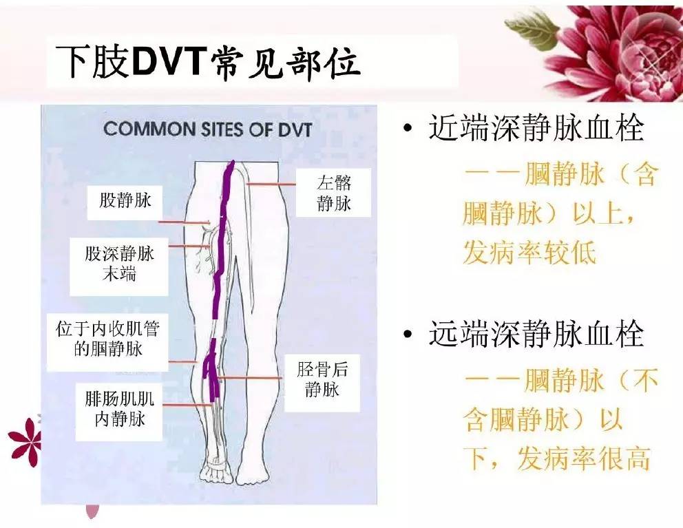 dvt下肢静脉血栓的预防及护理