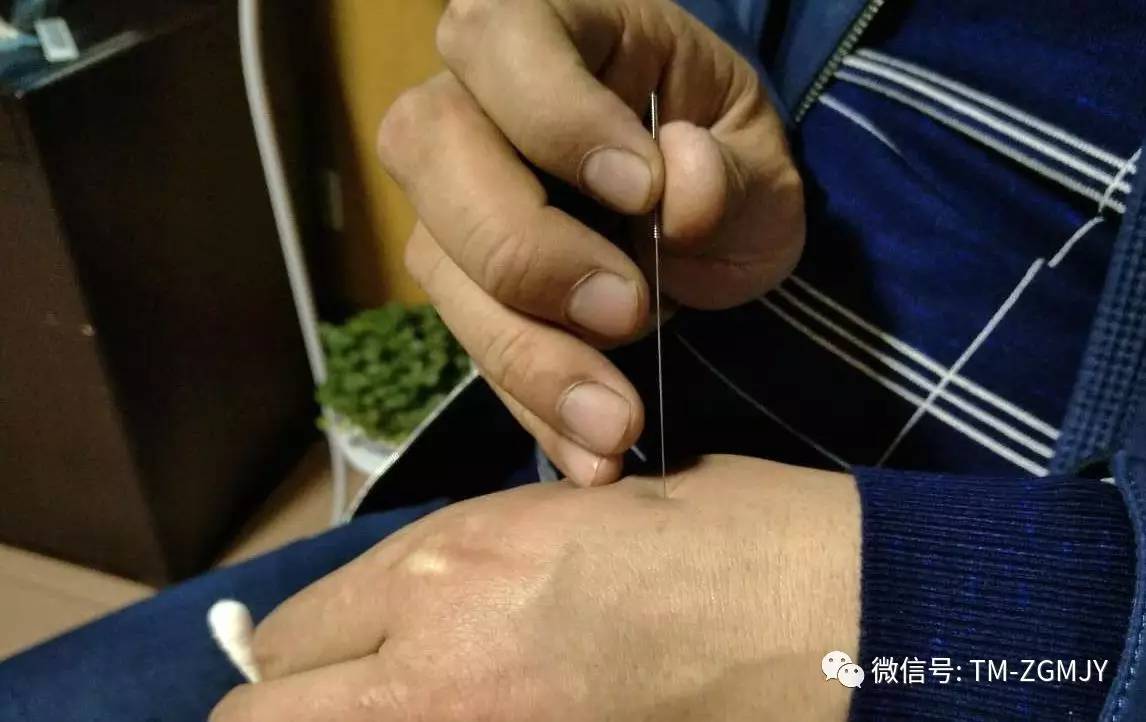 烧山火针刺法结合柴术汤治疗过敏性鼻炎68例