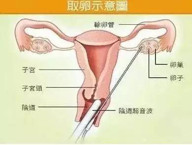 白色的那根棒状物其实是阴道超声,很多来捐卵的女生会误以为这就是