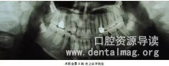 上颌埋伏阻生尖牙正畸治疗的临床疗效分析
