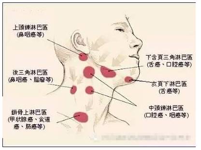 颈部淋巴结能买保险吗 颈部淋巴结核能不能买保险